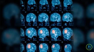 Brain Cancer Patients And Cannabis