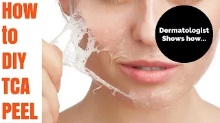How to TCA peel- Tutorial by Dermatologist