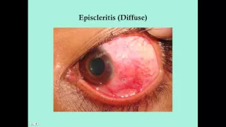 Scleritis - CRASH! Medical Review Series