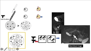 Diffusion weighted imaging (3/4)- DWI, ADC & b values simplified