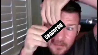 Michael Bisping Pops Out Prosthetic Eye