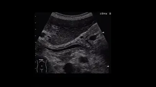 Cholangitis #ultrasound #radiopedia #videoshorts#ct#mri#xray#basics#radiant#best#youtube#daily#tips