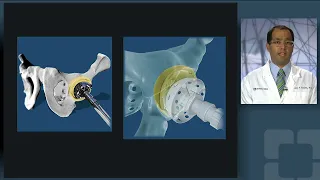 ZimmerBiomet ROSA Robotic Total Hip Replacement: Case Example of Complex Hip Dysplasia