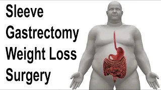 Sleeve Gastrectomy Weight Loss Surgery