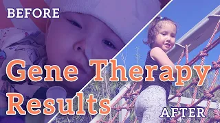 AADC Deficiency Before and After Gene Therapy