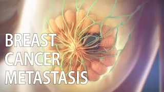 Breast cancer metastasis animation | spread of cancer | medical animation