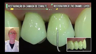 TOP 2 ERRORS in the treatment of a wedge shaped defect of teeth