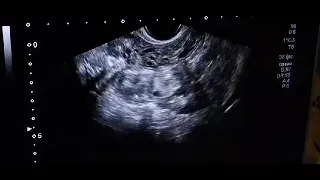 Chronic Ectopic Pregnancy Ultrasound Scan