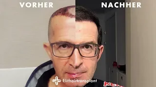 Haartransplantation Vorher Nachher! | Elithairtransplant Ergebnisse