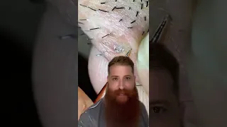 Pelo encravado na barba