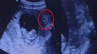 A creepy ultrasound photo that appears to show a 'demon' watching over an unborn baby has gone viral