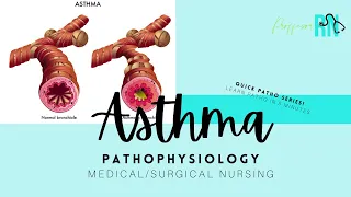 Quick Pathophysiology / Asthma / Med-Surg Nursing / Watch an asthma attack!