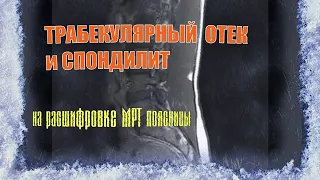 ТРАБЕКУЛЯРНЫЙ ОТЕК modic 1 и СПОНДИЛИТ поясничного отдела на расшифровке МРТ (ВТОРОЕ МНЕНИЕ)