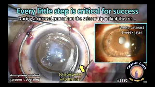 CataractCoach 1380: every little step of surgery is critical for success