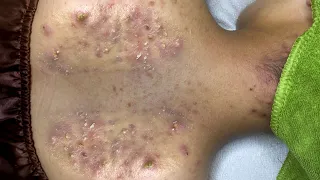 Suri Job #563: So Many Blackheads and Whiteheads in Back