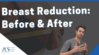 Plastic Surgeon Reviews Breast Reduction Before and After Pictures