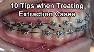 10 Tips when Treating Extraction Cases