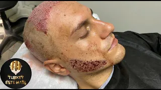 Трансплантация волос зоны бороды и головы, методом FUE