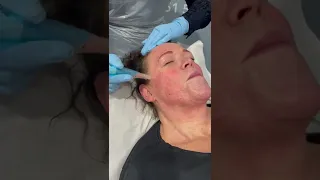 Repairing ACNE SCARING WITH MICRO NEEDLING-Subscribe below for more -Amanda