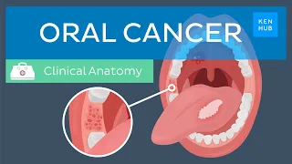 Oral cancer: Epidemiology, risk factors, prevention, symptoms and treatment | Kenhub