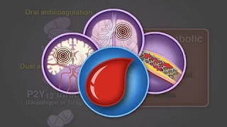 Preventing Thrombosis after PCI