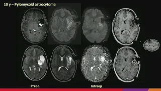 Imaging for Neurosurgical Procedures in Pediatrics