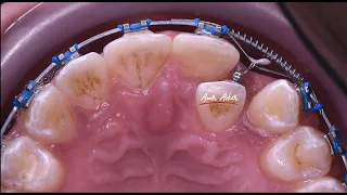 Double wire technique in orthodontic piggy back, correcting cross bite