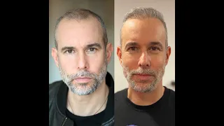 5 Months In My Hair Transplant Q&A