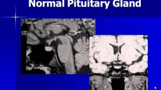 Normal imaging of the pituitary