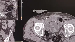 Small bowel obstruction - adhesions - How to approach a  CT scan - Radiologist's point of view