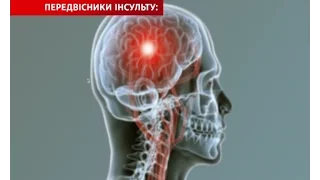 Як вчасно розпізнати інсульт