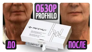 Филлеры больше не нужны?Обзор препарата Profhilo