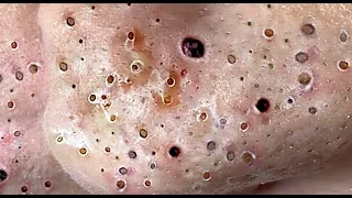 Relax Skincare Everyday with Acne Blackheads Treatment Spa #97910