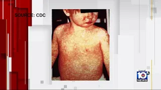 Signs to look out for as measles cases reported at Broward school