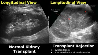 Renal Transplant Doppler Ultrasound Normal Vs Abnormal Images | Transplant Complication | Kidney USG