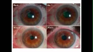 Reza Dana: Translational Research Applications in Ocular Surface Inflammatory Disorders