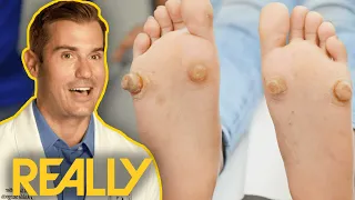 Dr Brad Blown Away By Severe Foot Growths | My Feet Are Killing Me