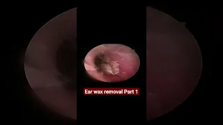 Ear wax removal #shots #earwaxremoval #耳垢掃除