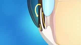 Glaucoma Animation