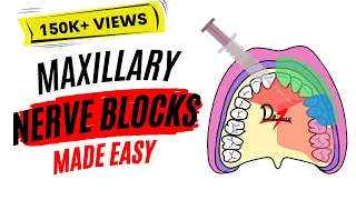 Maxillary Nerve Block: Anesthesia For Dental Procedures