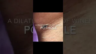 DPOW or Pothole? 😯 #shorts #drpimplepopper #drsandralee