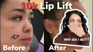 10K LIP LIFT BY DR BEN TALEI