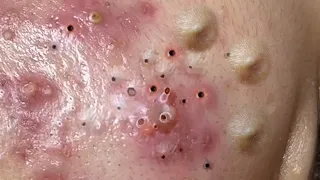 Relax everyday with spa #309 Popping huge blackheads and Pimple Popping - Best Pimple Popping Videos