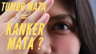 Benarkah Tumor Mata = Kanker Mata,  dr Yulia BERI PENJELASAN, SIMAK VIDEO BERIKUT