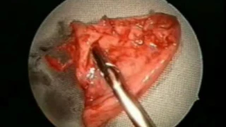 Schwannoma in Infratemporal fossa - Dr. P.J .Wormald