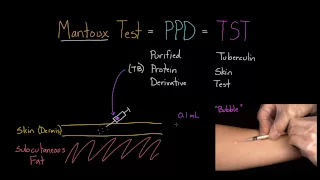 Mantoux Test (aka. PPD or TST)