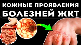 Экзема уйдет за неделю! Гладкая кожа без зуда, трещин и корочек. Улучшить качество кожи поможет…