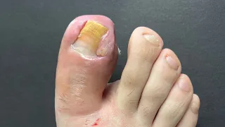 LIVE CASE: REMOVAL OF MAMMOTH INGROWN TOENAILS!!!