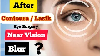 Blur Vision after lasik surgery ? Blurred vision after Contoura Lasik Eye surgery ?