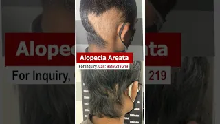 Here's What People Are Saying About Alopecia Treatment. #alopecia_treatment #shorts  #skinaaclinic